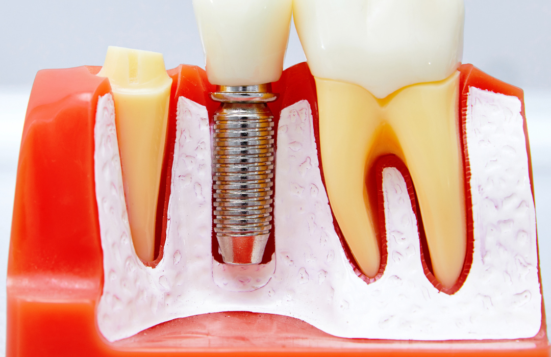 The Dental Implant Procedure