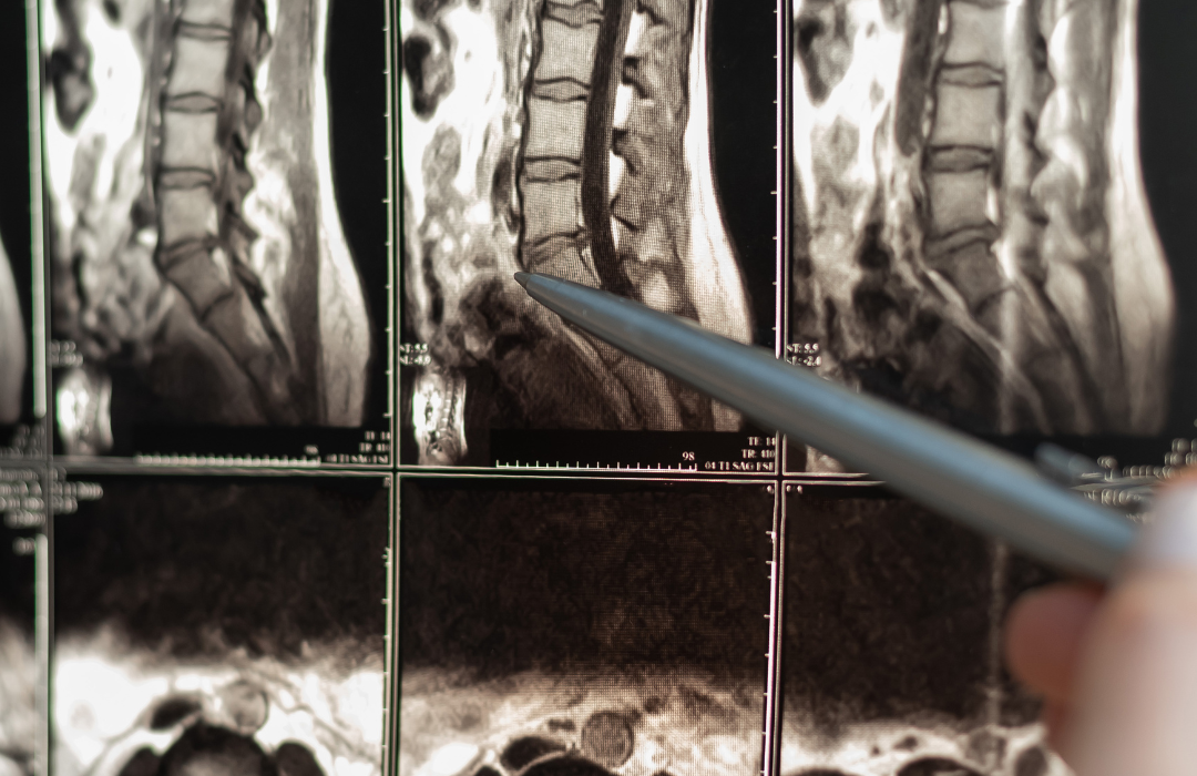 Life with Spinal Cord Injuries
